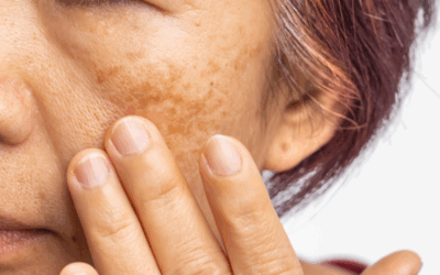 Beyond the Surface Understanding and Treating Melasma Safely