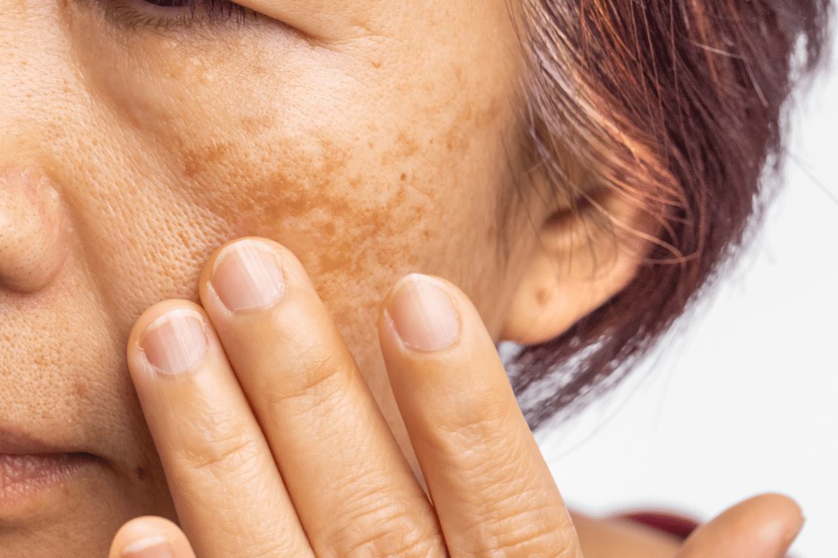 Beyond the Surface Understanding and Treating Melasma Safely
